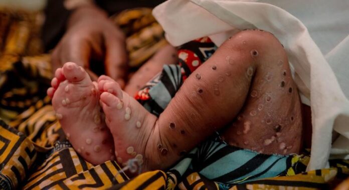 OMS e países coordenam resposta para acabar com surtos de Mpox em África