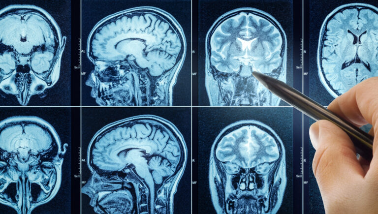 Famoso remédio para pressão alta surpreende ao impedir avanço de tumor cerebral
