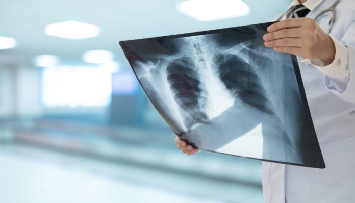 Comissão de Saúde debate incorporação da terapia tripla para tratamento Comissão de Saúde debate incorporação da terapia tripla para tratamento da fibrose cística - Notícias